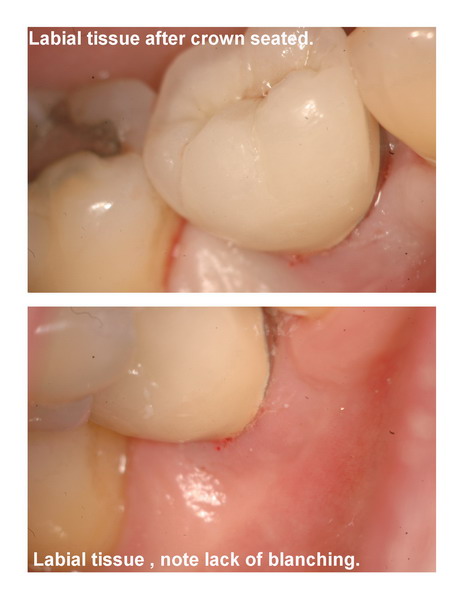 Implant seating pg 5 edited_resize.jpg